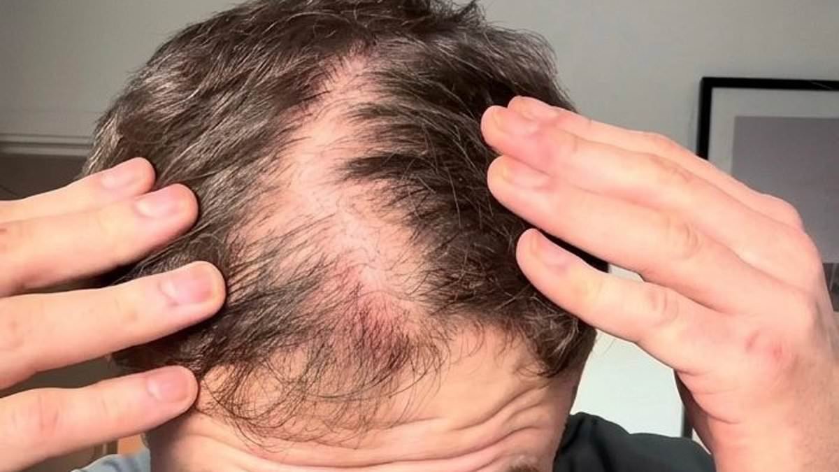 I started going bald at 25. Now I have REVERSED my hair loss with this DIY at-home routine and combination that takes just a few minutes a day. But be warned, it comes with major sacrifices