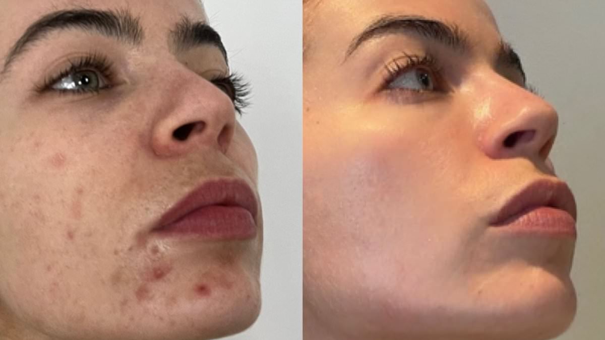 I've always been embarrassed by my spotty skin. I'd tried every lotion and potion, until I found a science-backed plan that restored my skin's health… and my confidence