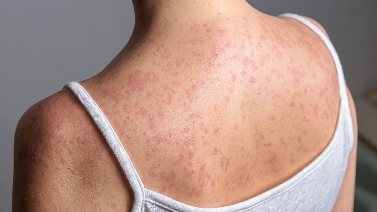 Measles outbreak hits schools and nurseries in north London with more than 60 children infected