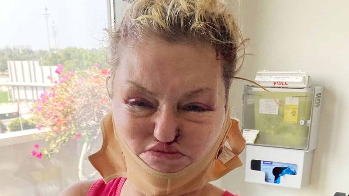 Danniella Westbrook is almost unrecognisable as she emerges from hospital with a swollen face after undergoing extensive facial reconstructive surgery in Dubai
