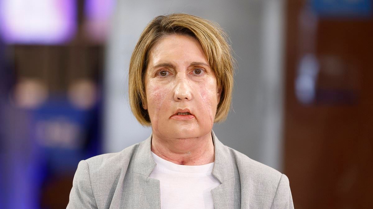 Woman with flesh-eating disease receives face transplant from assisted death donor