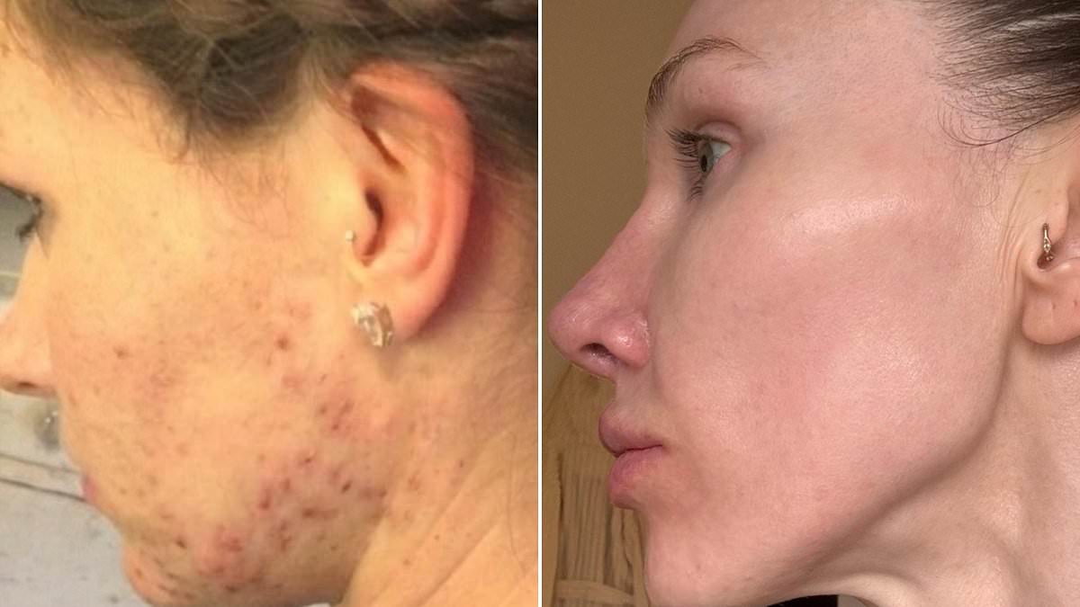 Adult cystic acne ruined my life and made me so paranoid I couldn't leave the house without thick foundation. Now I have the 'glass skin' of my dreams. Here's how I cured it for good