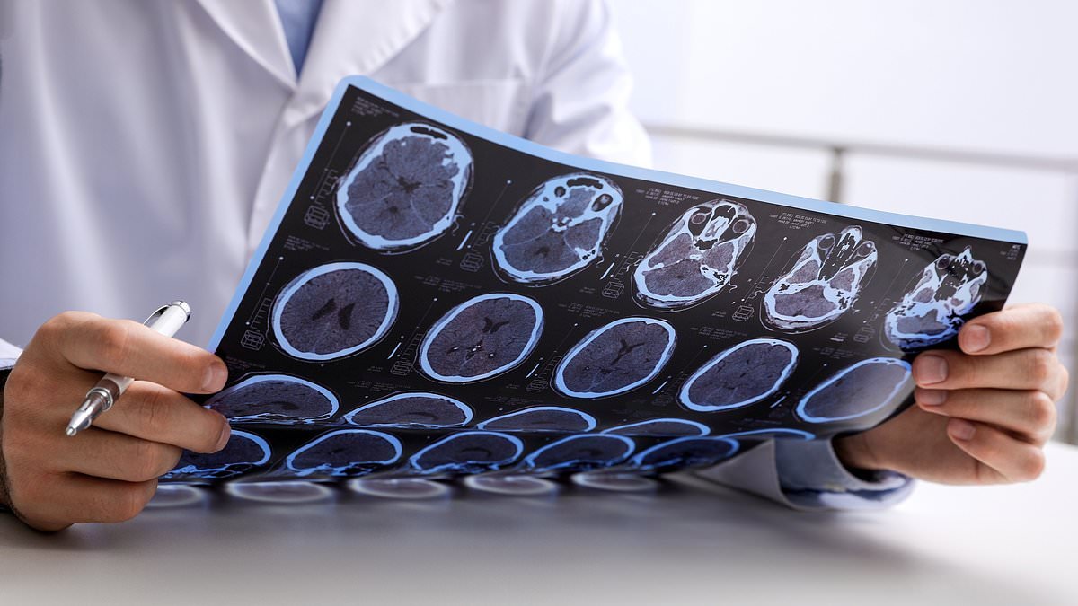 Multiple Sclerosis experts pinpoint three lifestyle factors that increase your risk of dying from the disease