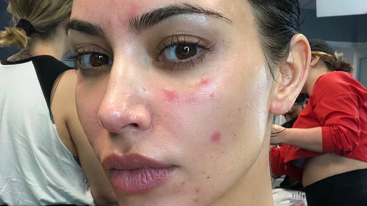 The psoriasis explosion - and how to cure it WITHOUT drugs: As cases soar, how so many go on to develop devastating conditions and doctors misdiagnose them. Now ETHAN ENNELS talks to world-renowned experts and reveals the answers