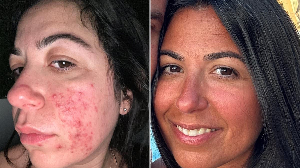 This cruel skin condition blighted my life for years. I tried all the solutions, but it was this dermatologist-approved fix that finally solved my problems. This is the shocking cause everyone is missing