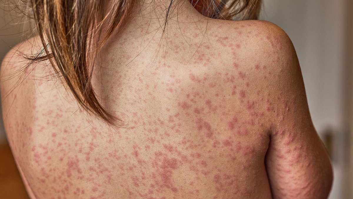 As fears London is about to be gripped by 'fast spreading measles outbreak', these are the warning signs... and it's not only a disease that infects children