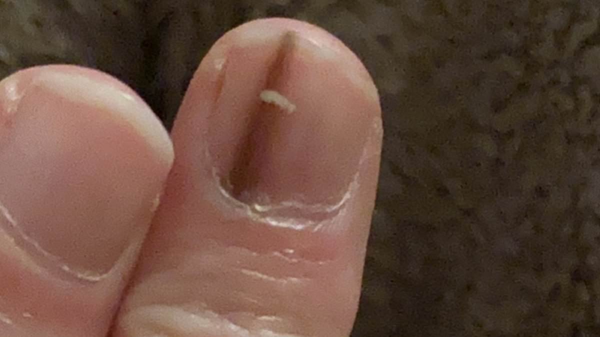 Doctors insisted a subtle change to my nail was nothing to worry about... in fact it was the ONLY sign of the deadliest kind of skin cancer. These are the easy-to-miss symptoms everyone must look out for