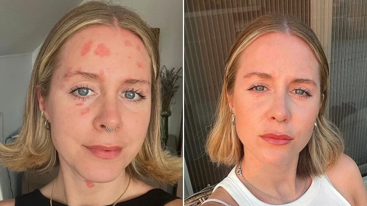 My psoriasis was so bad one cruel stranger asked if I had ringworm. But after 17 years trying countless treatments and giving up refined sugar, alcohol, dairy and wheat - THIS is what really works for me