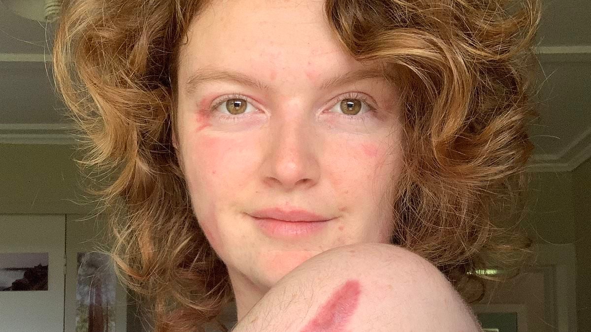 Kelsey Waghorn: White Island volcano survivor's gruesome injuries revealed - as she relives the moment the world erupted in a deadly fireball, killing 22 around her and maiming 25 more