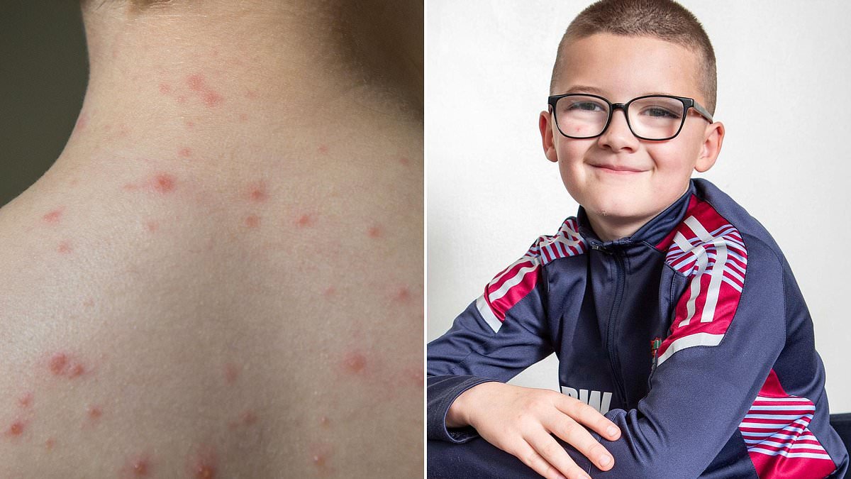 Roman got chickenpox at four. His family weren't concerned... until they found him collapsed with a high fever. This is the little-known complication that left him in a wheelchair... and his mother's message to all parents
