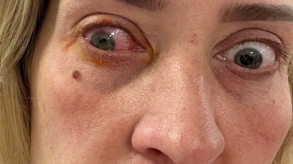 Mother-of-four, 36, left blind in one eye after leaving her contact lenses in for TWO WEEKS: 'Felt like I was stabbed'