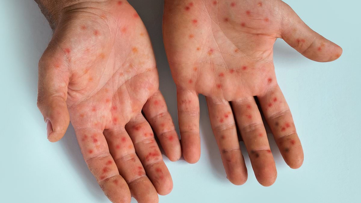 Travel warning issued as cases of Mpox rise in Spain