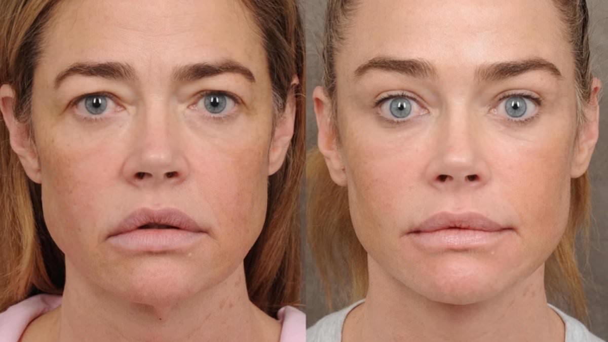 Denise Richards, 55, seen in shocking before and after photos from her FULL facelift 8 months ago