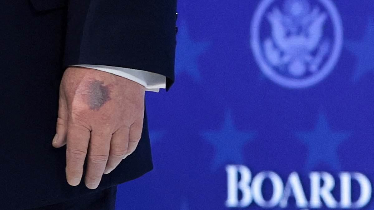 Trump is seen wearing thick make-up to cover up bruising on his hand during Davos conference amid continuing speculation over his health