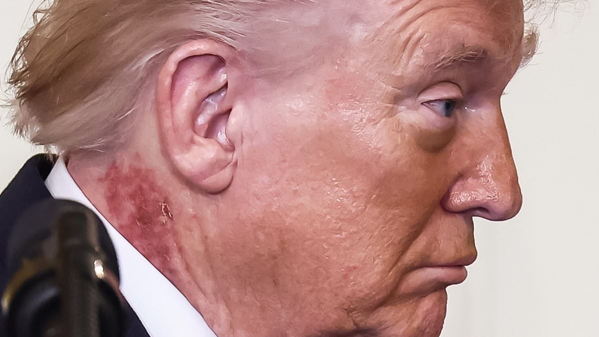 What is wrong with Trump's neck? Doctors reveal 'likely' cause of painful-looking rash that the White House say required 'preventative treatment'