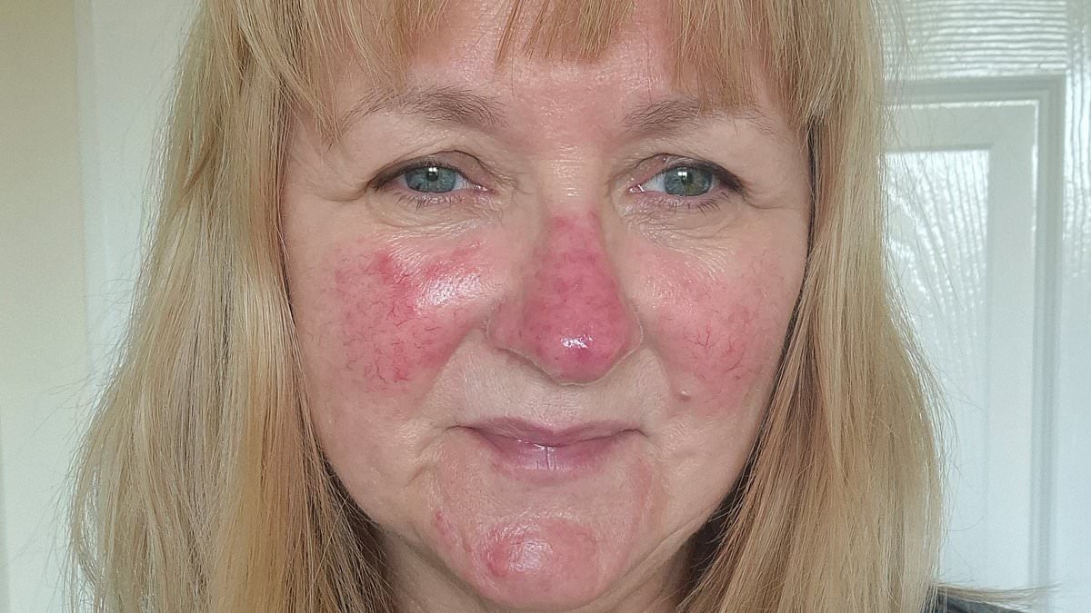 My rosacea was so bad, my colleague made this revolting comment about my face and I barely left the house for three years. No treatments worked... until I discovered this non-surgical miracle cure that changed my life