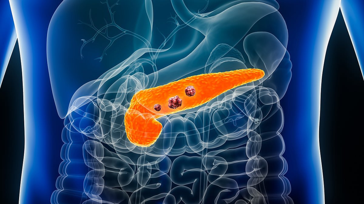 Hope for earlier detection of pancreatic cancer as scientists discover 'early warning signal' of deadly disease