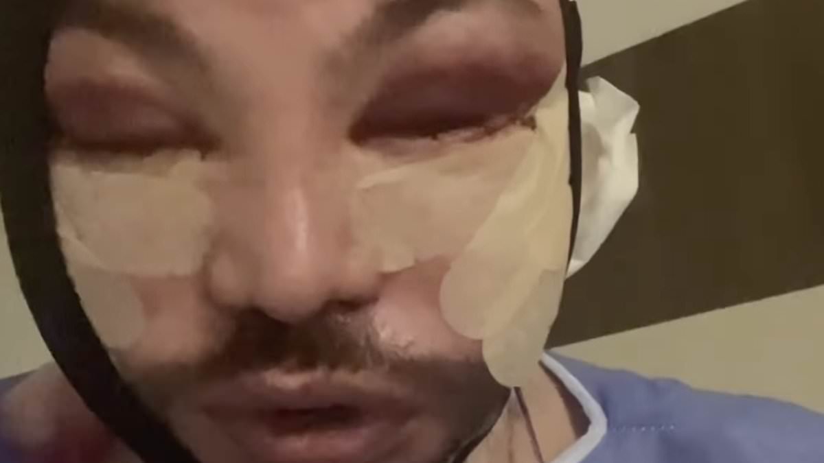 Why male tweakments are on the rise as Rylan Clark and Bobby Norris become latest stars to show off dramatic results of their 'traumatic' cosmetic procedures