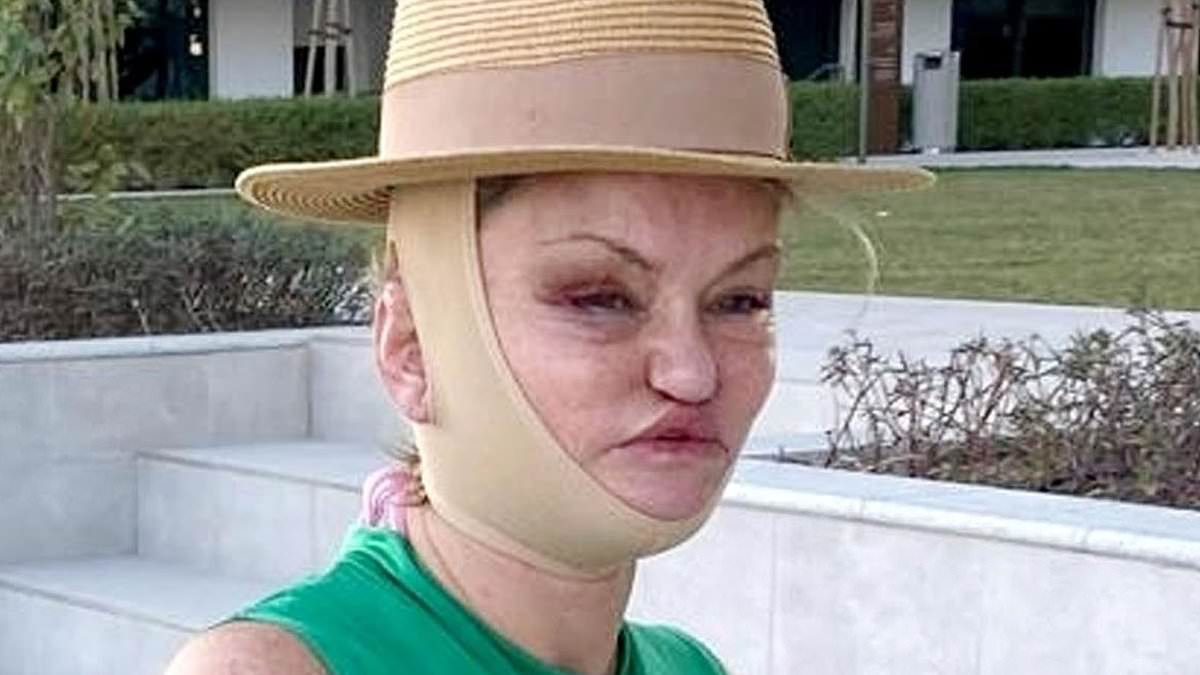 Danniella Westbrook remains bandaged and bruised in the wake of her facial reconstruction surgery as she continues her recovery in Dubai