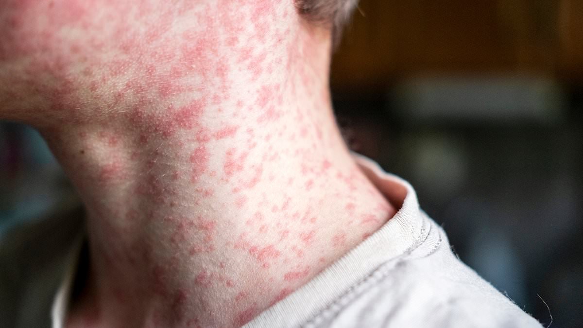 UK stripped of measles-free status as thousands of cases sweep Britain - and Europe hits record highs
