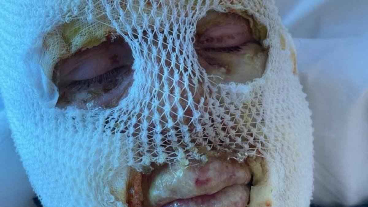 Two cousins suffered horrific facial burns after pub heater explosion, court hears