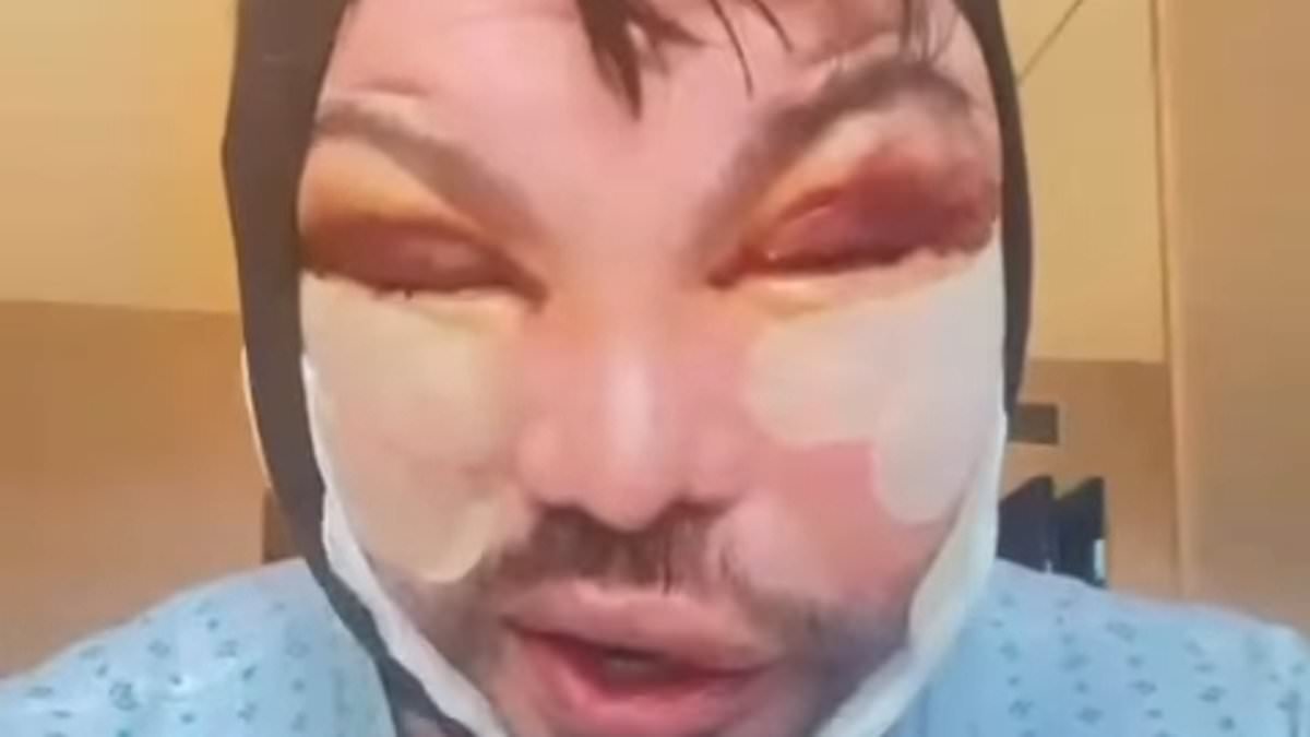TOWIE's Bobby Norris shows off his swollen and bruised face in new video to fans after undergoing more cosmetic surgery