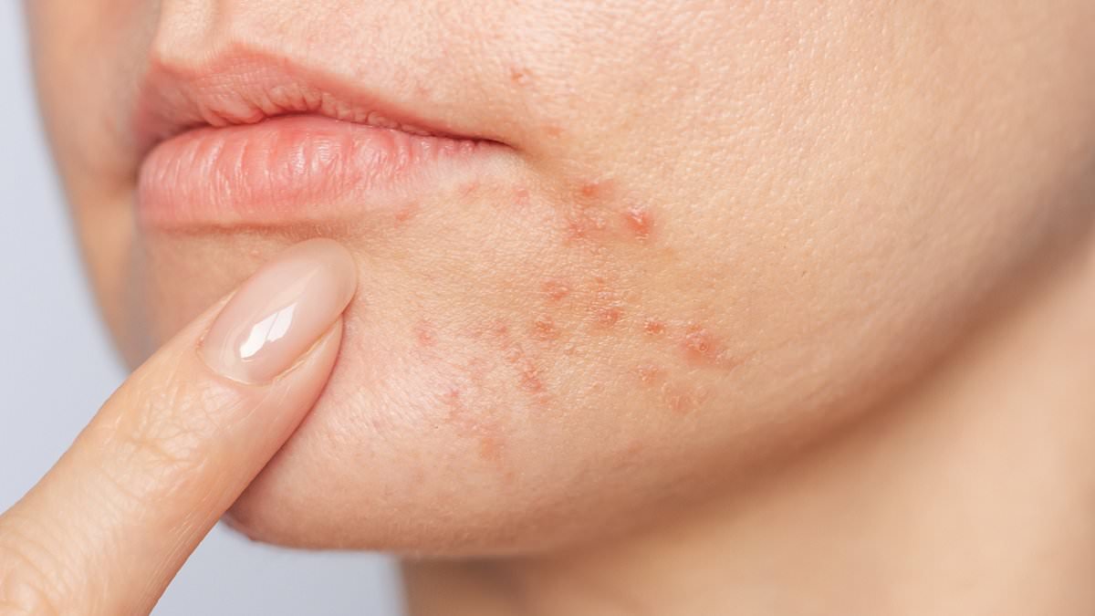 This little-known skin condition ruined my life. It's not acne, eczema or even rosacea - but a combination of all three that appears out of nowhere and affects thousands. These are the signs to watch for - and how I finally treated it