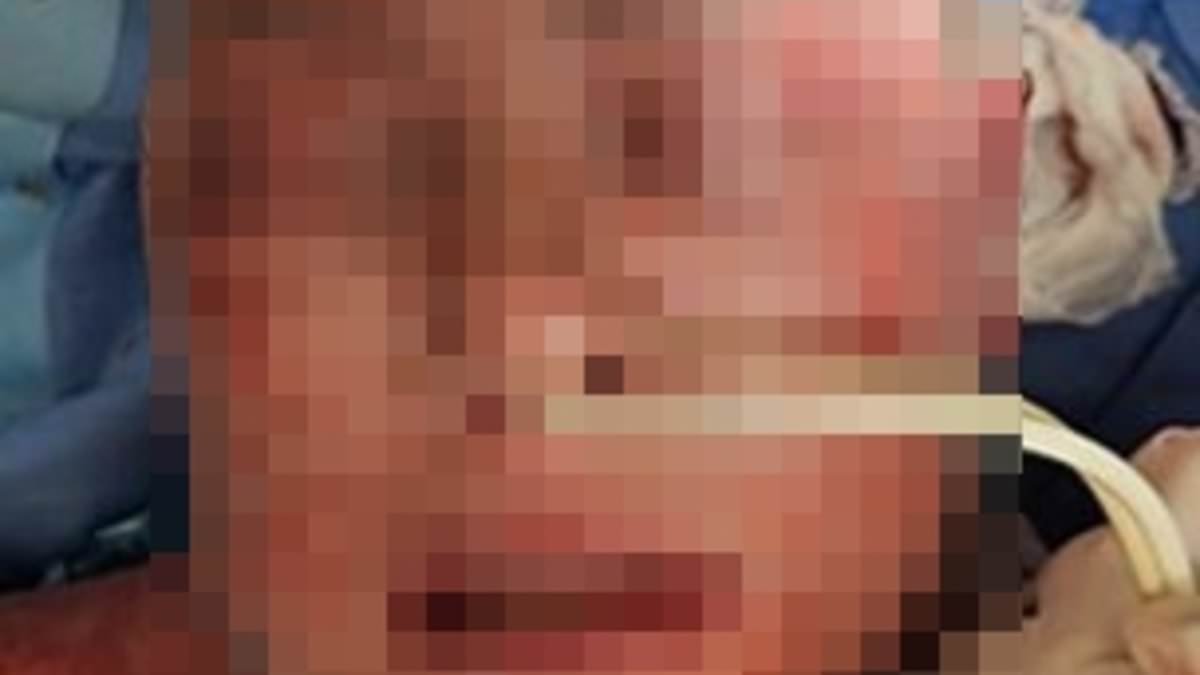 Woman, 42, left in extreme pain after a mental health drug taken by millions caused skin on her face to 'burn off'