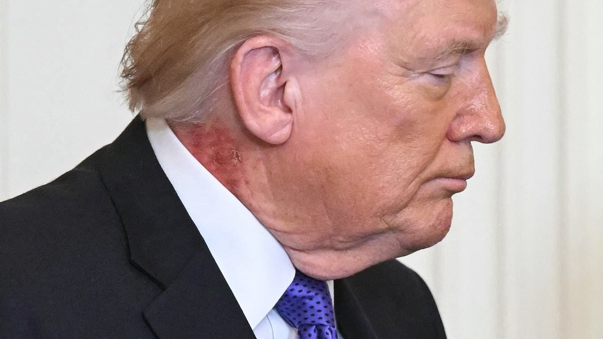 Trump sparks new health fears as viewers spot 'nasty' issue on his NECK