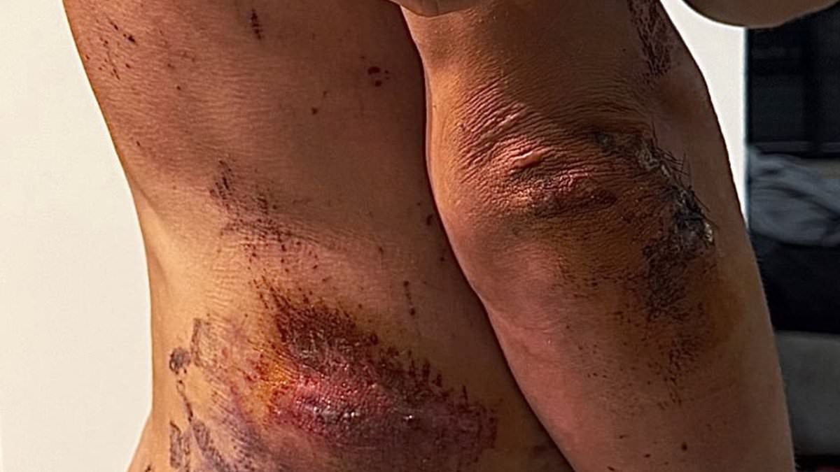Champion cyclist posts naked photo to reveal the scars from brutal crash that saw him collide with a sign post and a rival rider