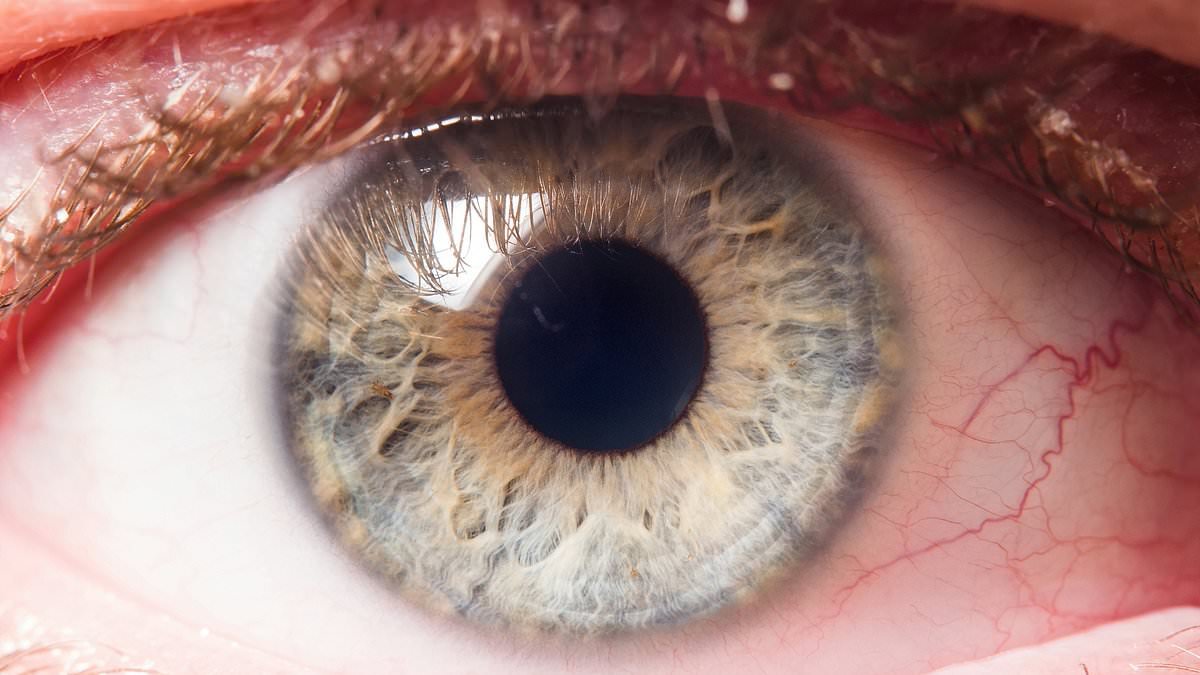 The silent blindness epidemic: Glaucoma cases soar as millions go undiagnosed