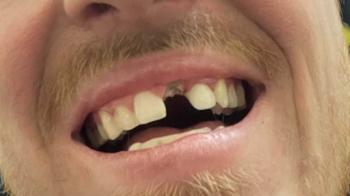 Father who was forced to GLUE his own teeth back in after failed veneer treatment wins £25,000 payout
