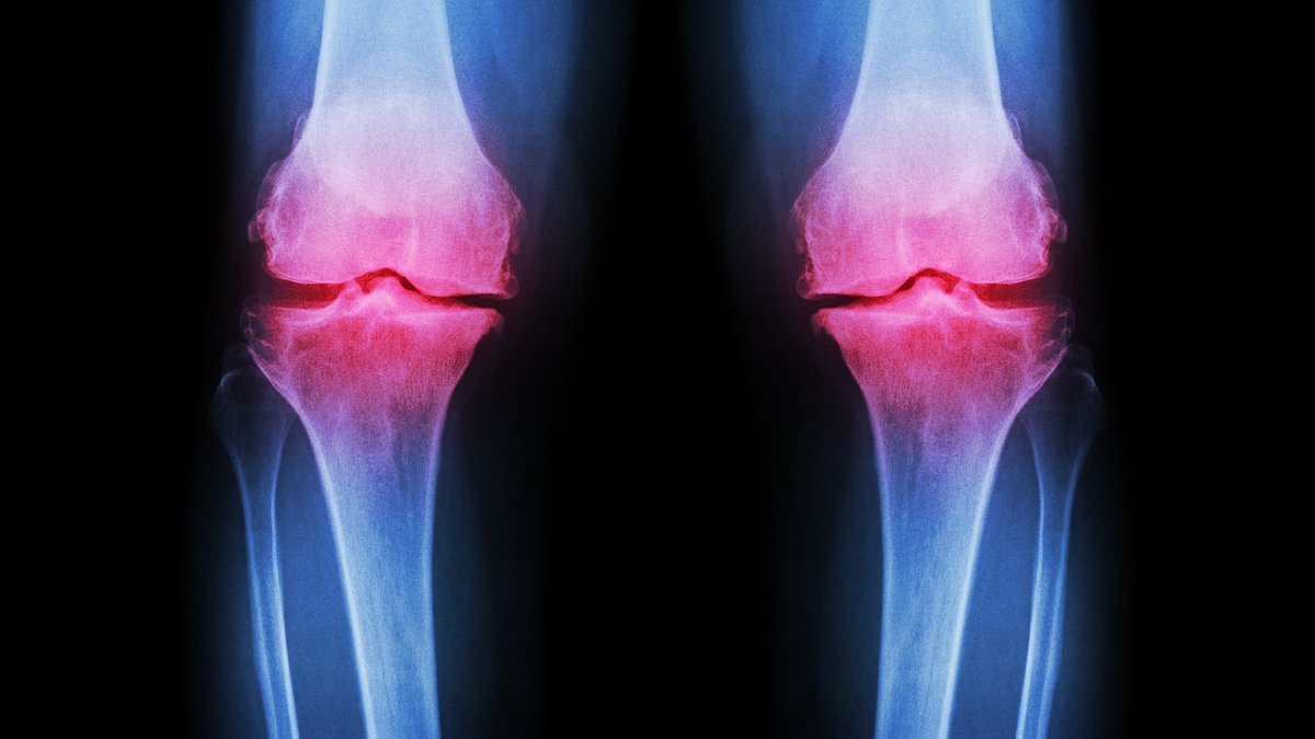 Experts reveal worrying cause behind the surge in younger people being diagnosed with bone injuries linked to osteoarthritis