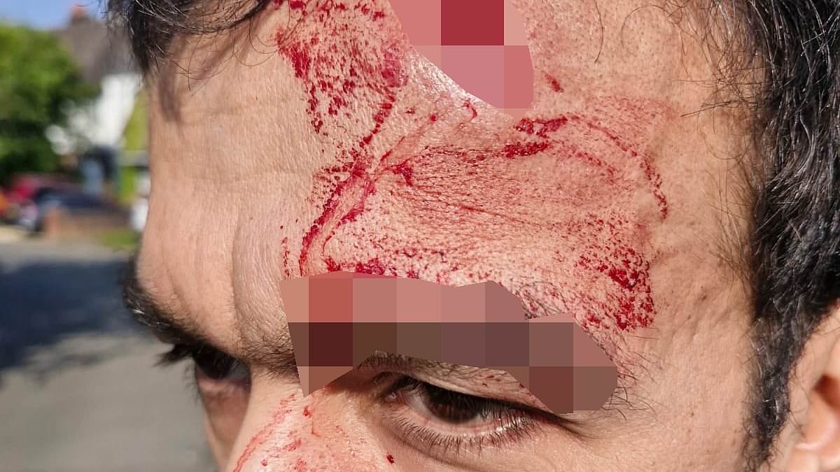 'I could have been killed in racist attack': The Zutons star reveals how his head was split open with 'piece of wood' after 'asking group of young men to stop smoking near his son'