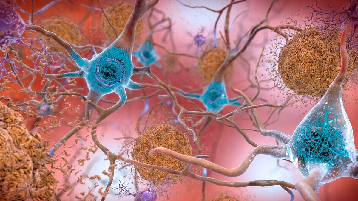 Dementia timebomb warning as scientists find Alzheimer's proteins in long Covid patients' blood