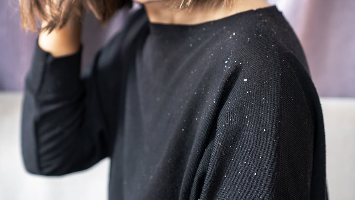 How a sudden attack of dandruff could be the first sign you're about to lose your hair: Mortifying reason more of us than ever are suffering from flaky scalps