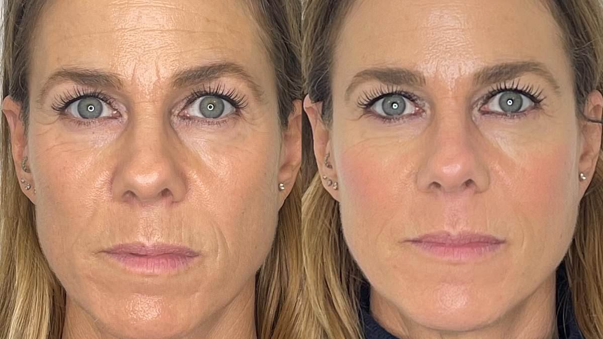 How a 'grief makeover' erased 20 years of family tragedy from my face. Here are the five tweakments that 'reupholstered' my forehead, cheeks and lips