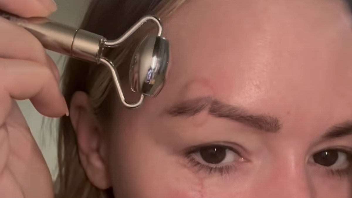 Laura Woods says she feels 'very conscious and struggles with her confidence' as she undergoes intense laser treatment for facial scars after horror accident