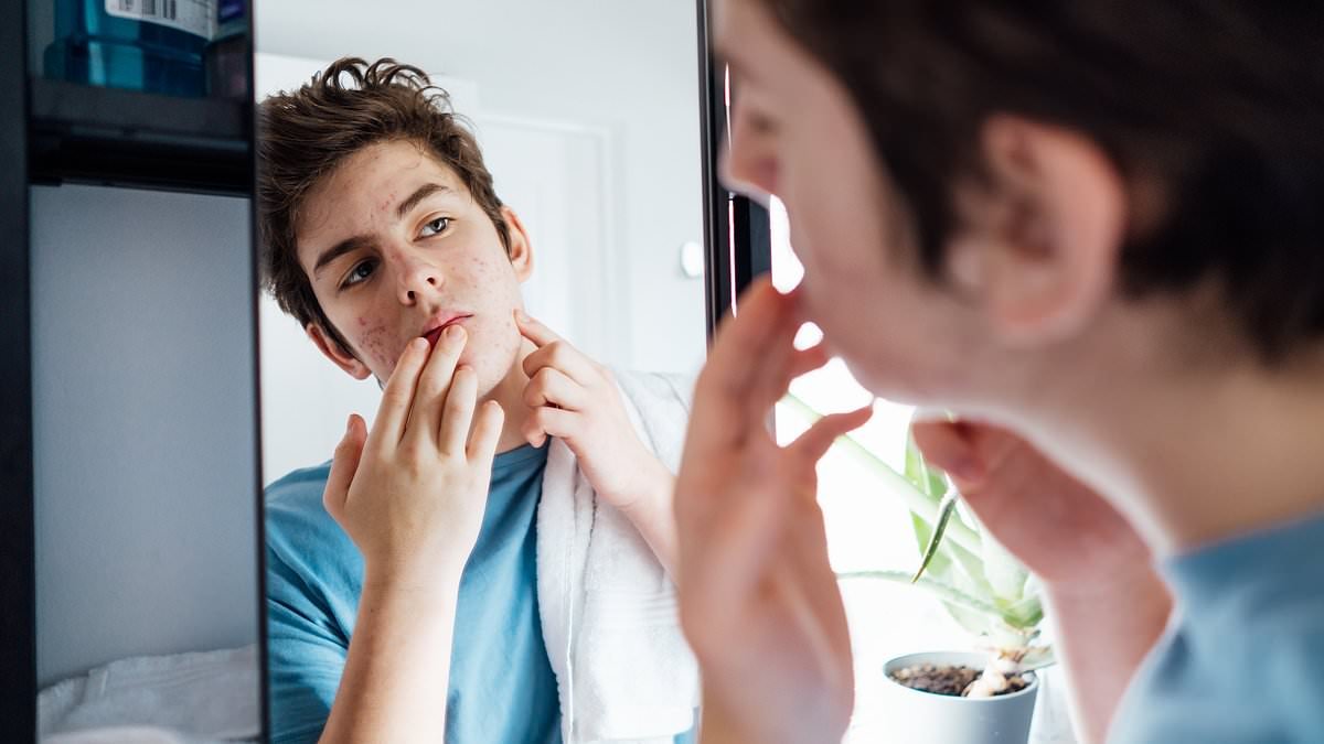 DR MAX PEMBERTON: I was tortured by debilitating acne for decades - here's how I cured it and what you should do if you're struggling with your skin