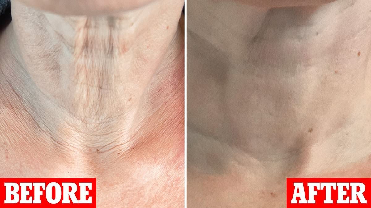 I'm a beauty editor who lost 10kg on Ozempic, but I was left with an ugly turkey neck, saggy skin, hair loss and worse - here are the tricks I used to fix them ALL at 50